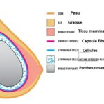 implants mammaires Tunisie