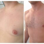 gynecomastie tunisie