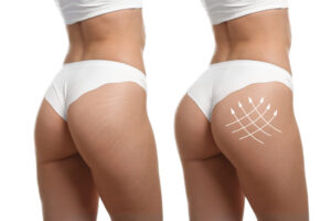 augmentation fesses Tunisie