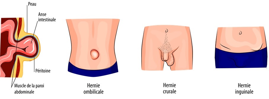 chirurgie hernies abdominales et pariétales