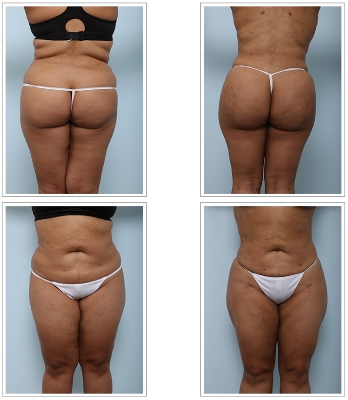 Liposuccion fesses Tunisie