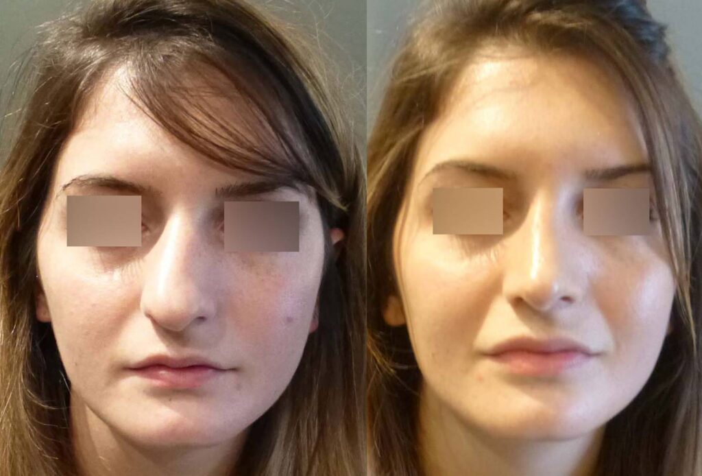 Turbinoplastie et correction septum dévié